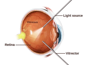 Vitrectomy: The Most Common Method for Fixing Retinal Detachments